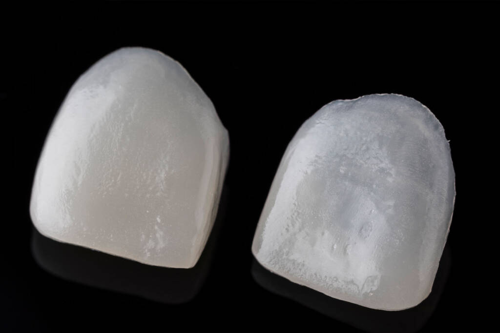 Detaljan prikaz dentalnih ljuskica od vrhunske keramike koje simuliraju prirodnu caklinu zuba u klinici Aesthetica Zagreb